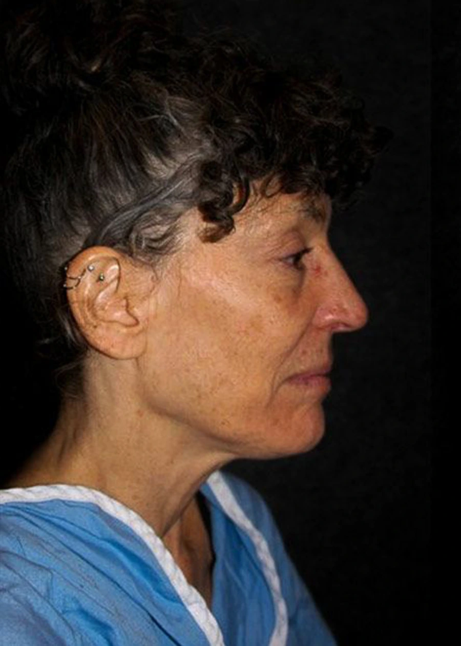 Rhinoplasty Patient 4 Set 2