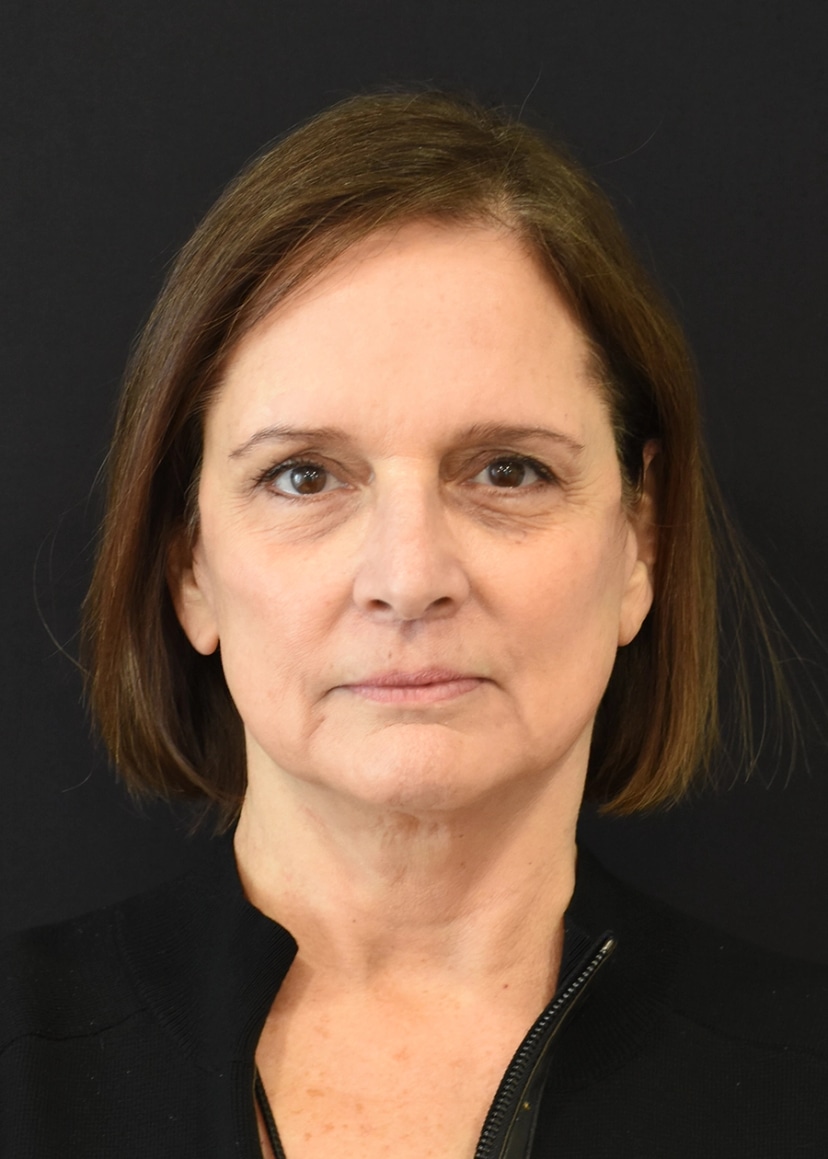 Extended Deep Plane Facelift Patient 6 Set 1 After